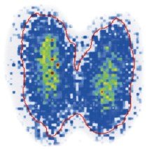 Radioisotope scan of the thyroid