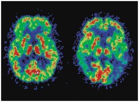 PET scans of normal and Alzheimer's disease brains