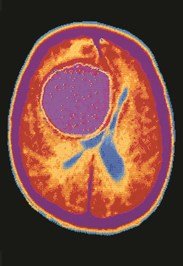 CT scan showing a brain tumor