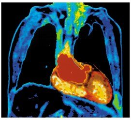 MRI scan of heart and lungs