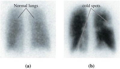 Lung scan showing normal and cold spots