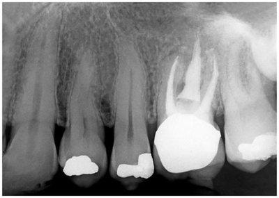 Calcium hydroxide in dentistry
