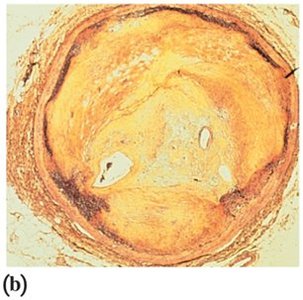 Artery clogged by cholesterol plaque