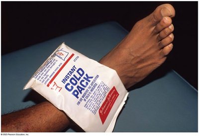 Instant cold pack applied to an ankle