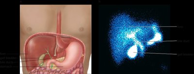 Gall bladder imaging with technetium-99m