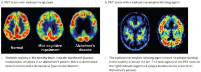 PET scans showing normal, mild cognitive impairment, and Alzheimer's disease brains