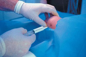 Radioisotope injection for arthritis treatment