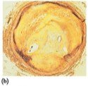 Artery clogged by atherosclerotic plaque