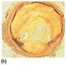 Artery clogged by cholesterol plaque