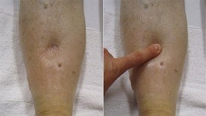 Pitting edema demonstration