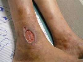 Ischemic ulcer