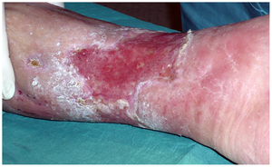 Venous stasis ulcer