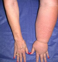 Lymphedema in arm