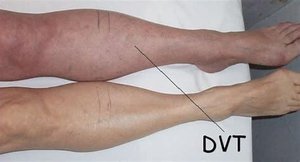 Deep vein thrombosis (DVT)