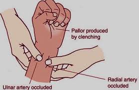 Modified Allen's test - occlusion