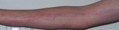Red streaks from blood poisoning