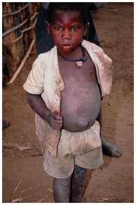 Child with signs of protein deficiency