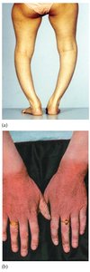 Images of vitamin deficiency diseases