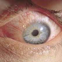 Miosis (pinpoint pupils) after nerve agent exposure