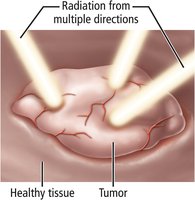 Radiation treatment targeting a tumor from multiple directions