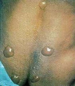 Blisters on skin after mustard exposure