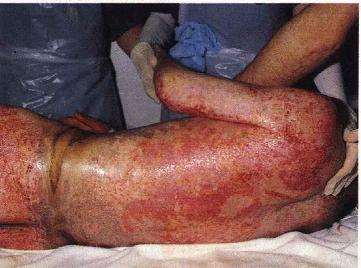 Blisters on foot from mustard gas