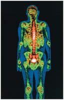 Isotope scan of skeleton