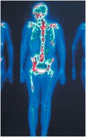 Isotope scan using Technetium-99 for bone imaging.