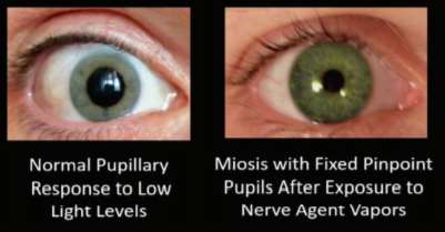 Normal vs. miosis after nerve agent exposure