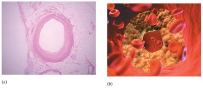 Plaque formation in arteries