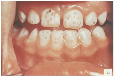 Teeth showing discoloration from excessive fluoride