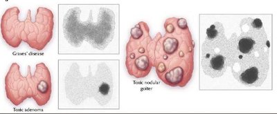 Radioactive iodine uptake in thyroid