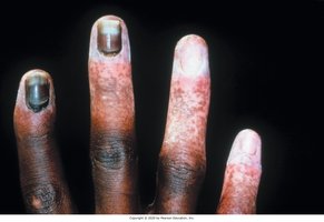 Necrosis of the skin