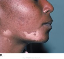Vitiligo