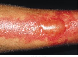 Partial-thickness burn with bulla
