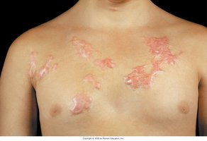 Keloid scar