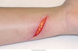Laceration exposing subcutaneous tissue