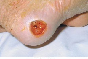 Pressure injury on heel