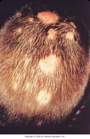 Tinea capitis (ringworm)