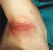 Severe contact dermatitis