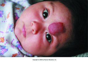 Hemangioma