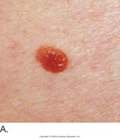 Pigmented nevus (mole)