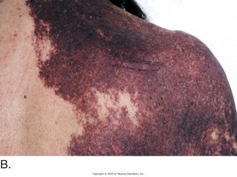 Port-wine stain nevus
