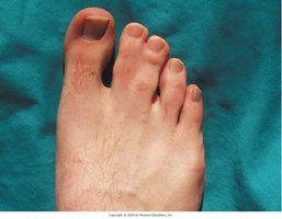 Syndactyly