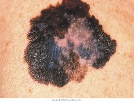 Malignant melanoma