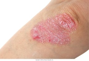 Psoriasis with silvery scales