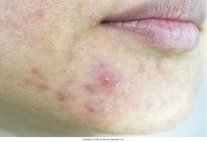 Acne vulgaris