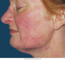 Acne rosacea