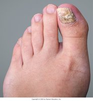 Onychomycosis