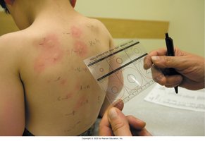 Allergy skin testing